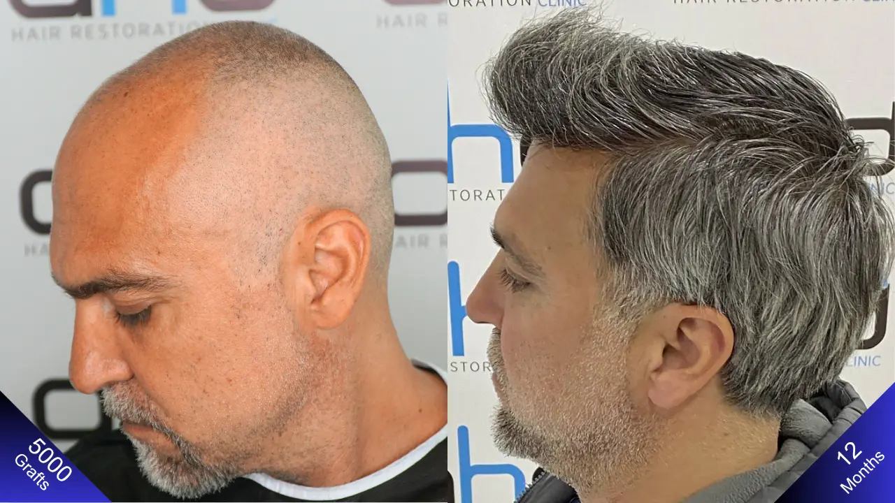 Натуральная густота благодаря пересадке 5000 графтов