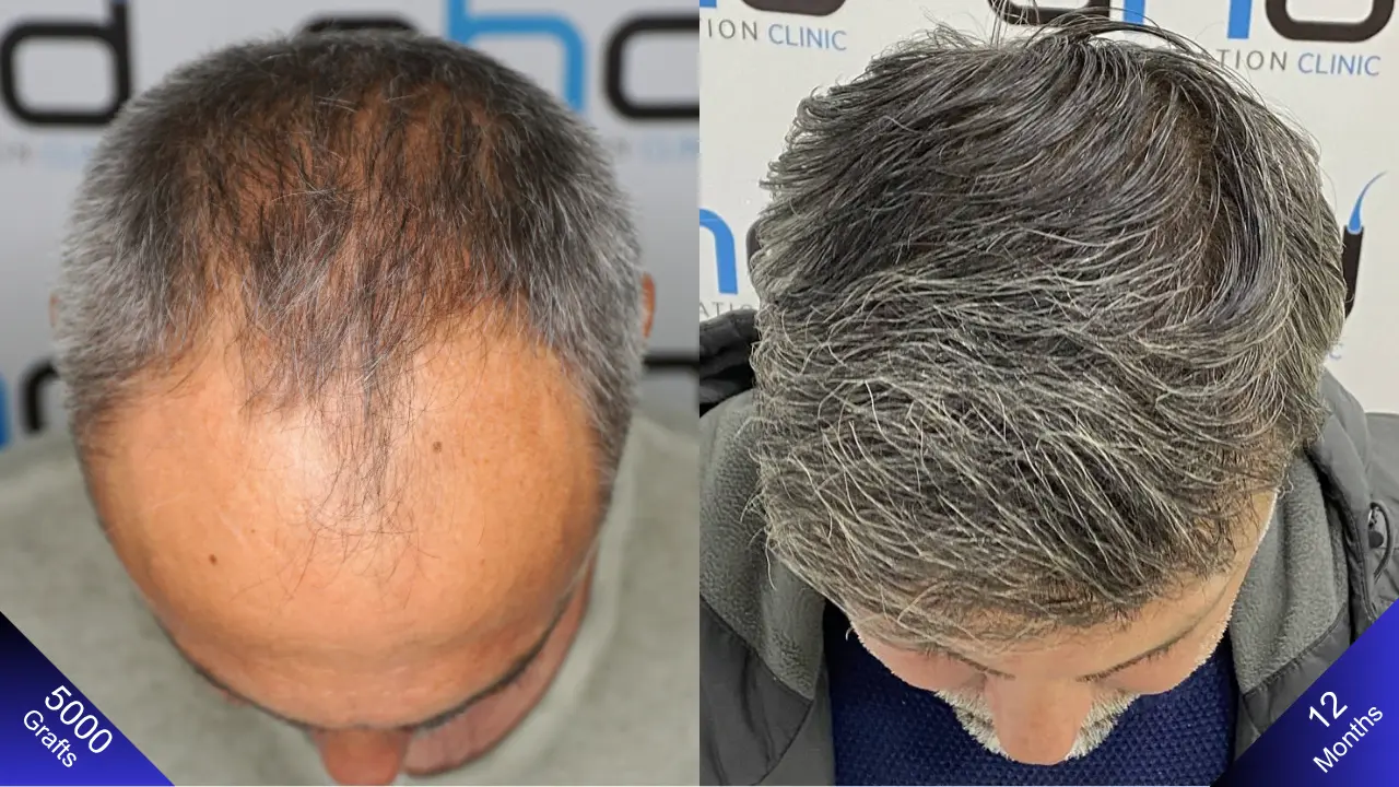 Вид сверху на мужчину с облысением по Норвуду 5, через год после пересадки волос