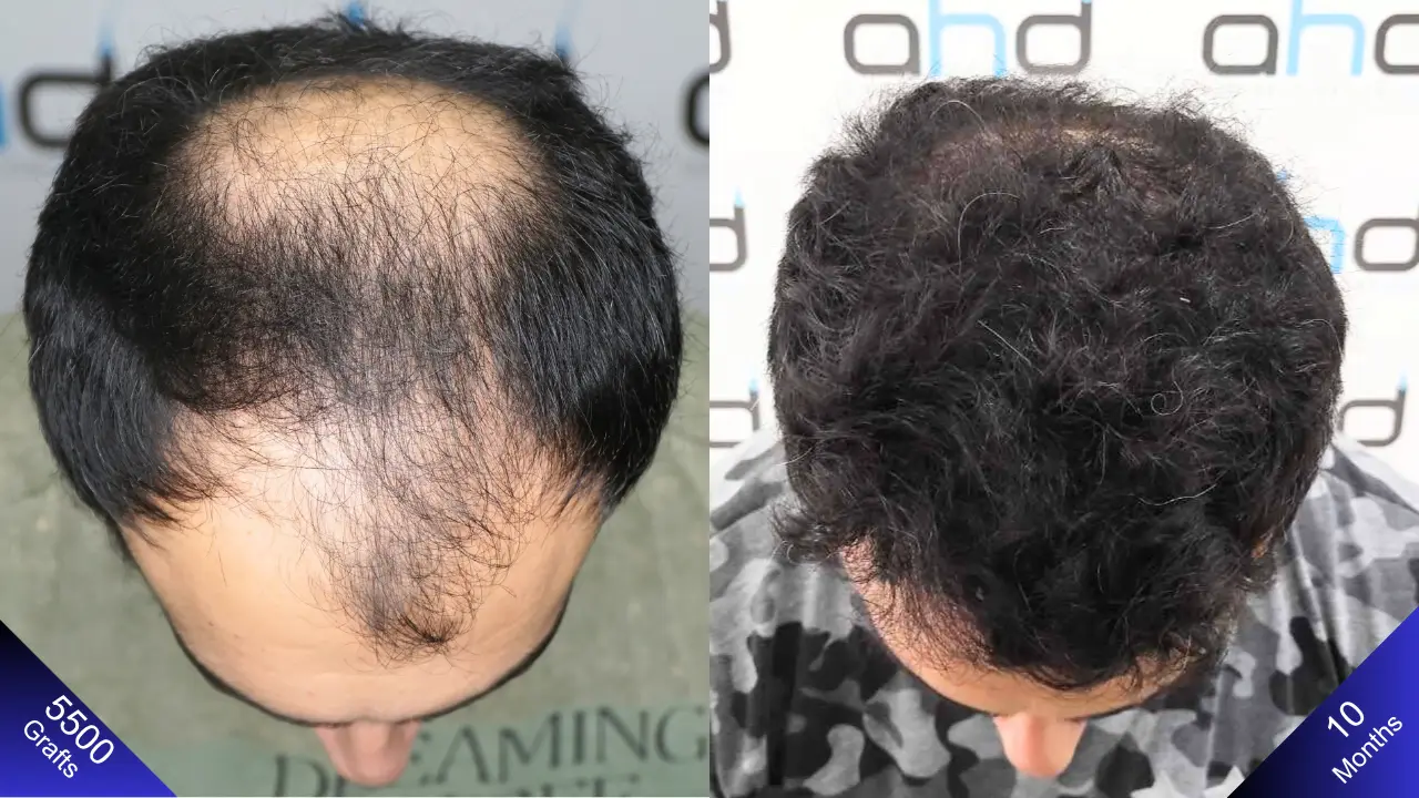 Пересадка 5500 графтов волос: удивительный результат через год