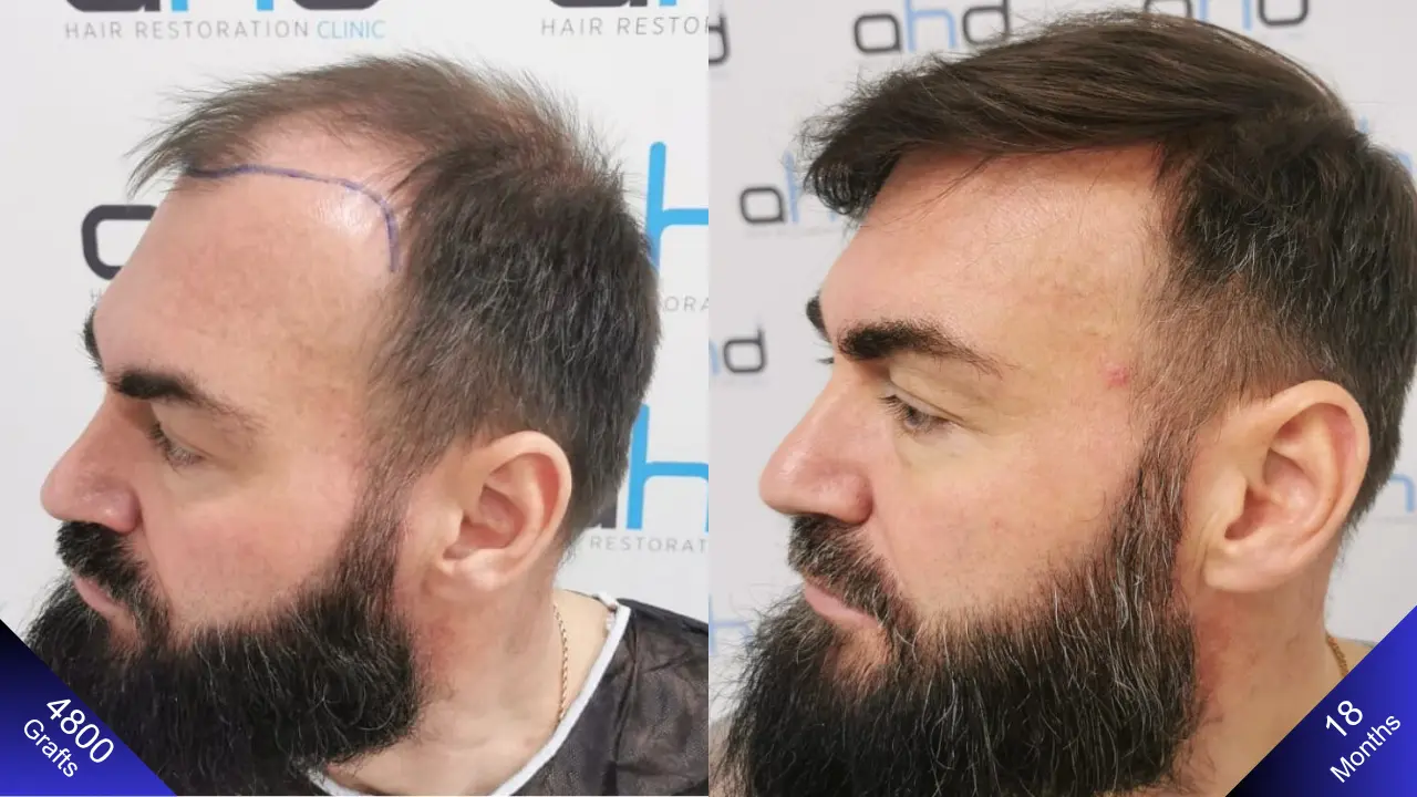 Потрясающий результат после пересадки волос