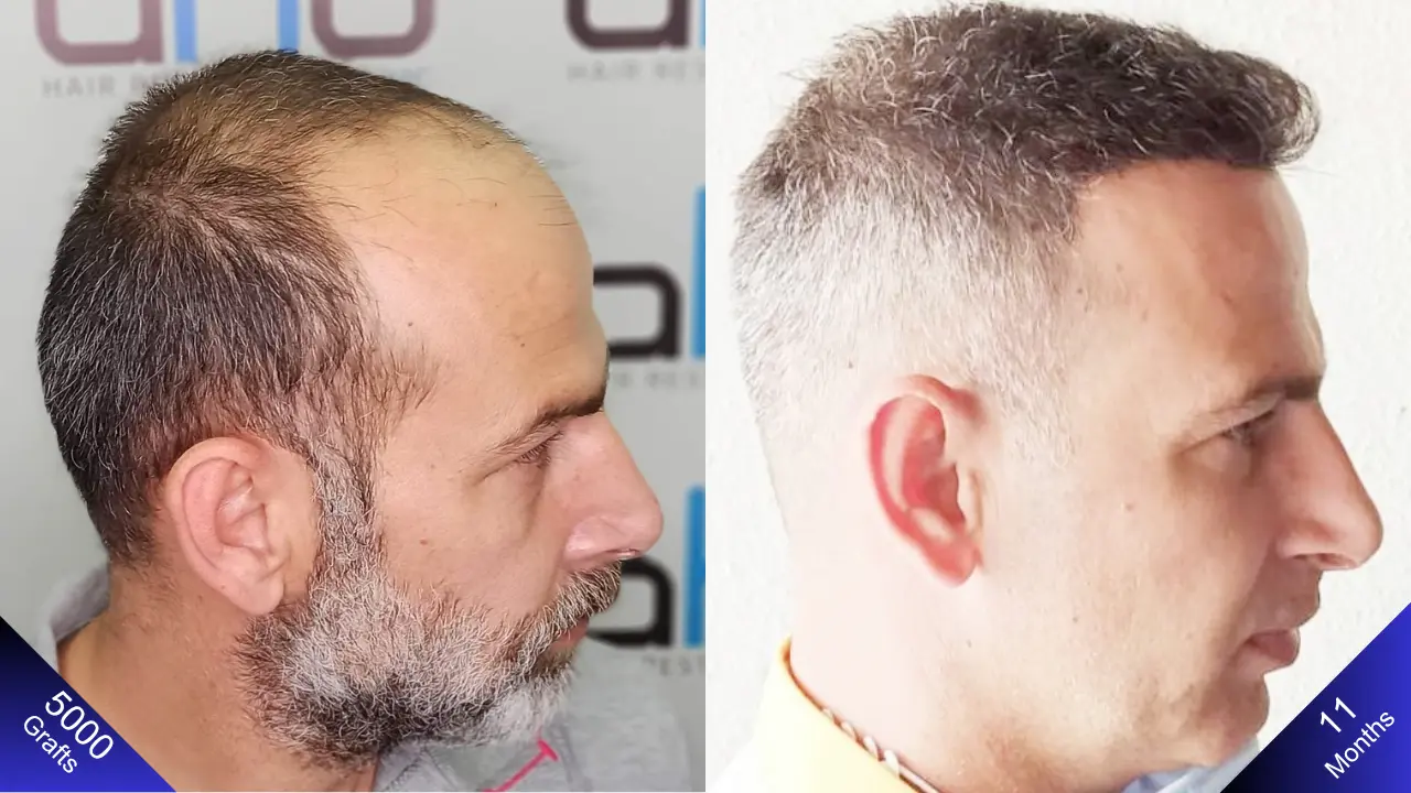 Естественная и высокоплотная имплантация волос