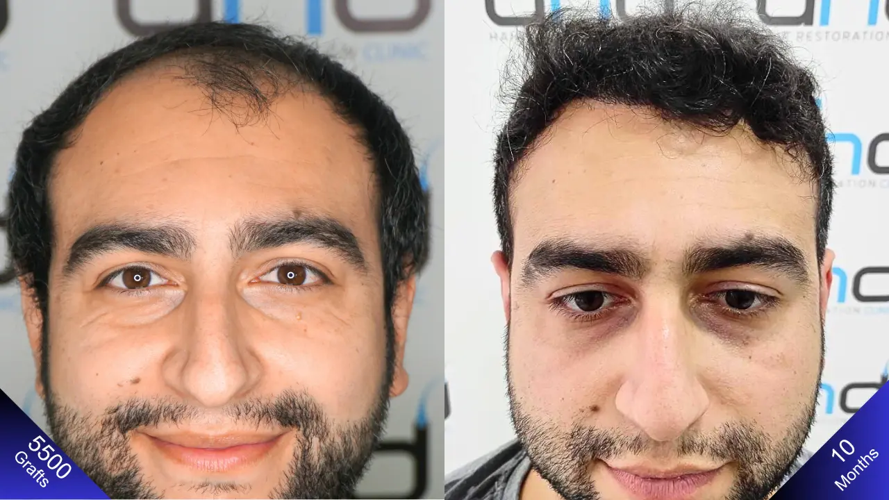 Потрясающий результат после 5500 графтов