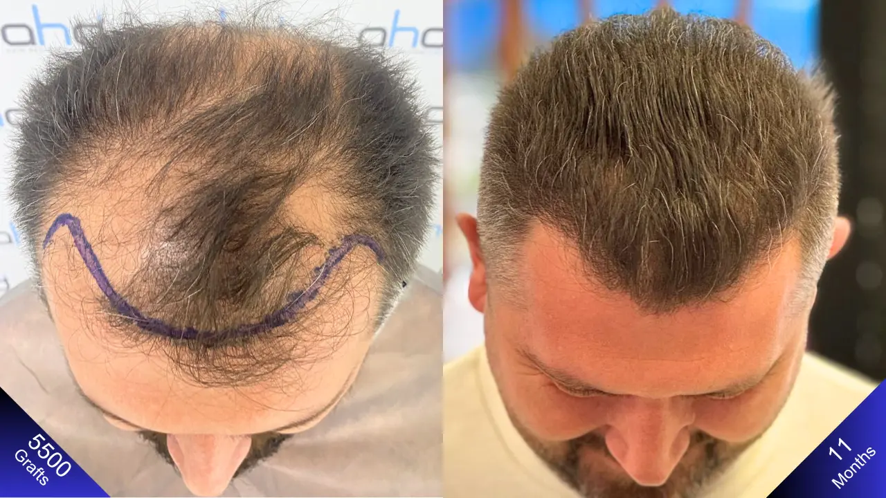 Процедура пересадки волос: вид сверху (Турция)