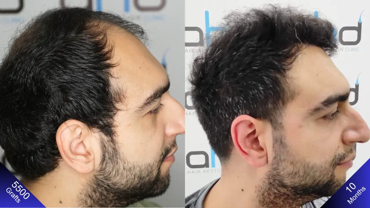 Восхитительные результаты пересадки волос в Турции