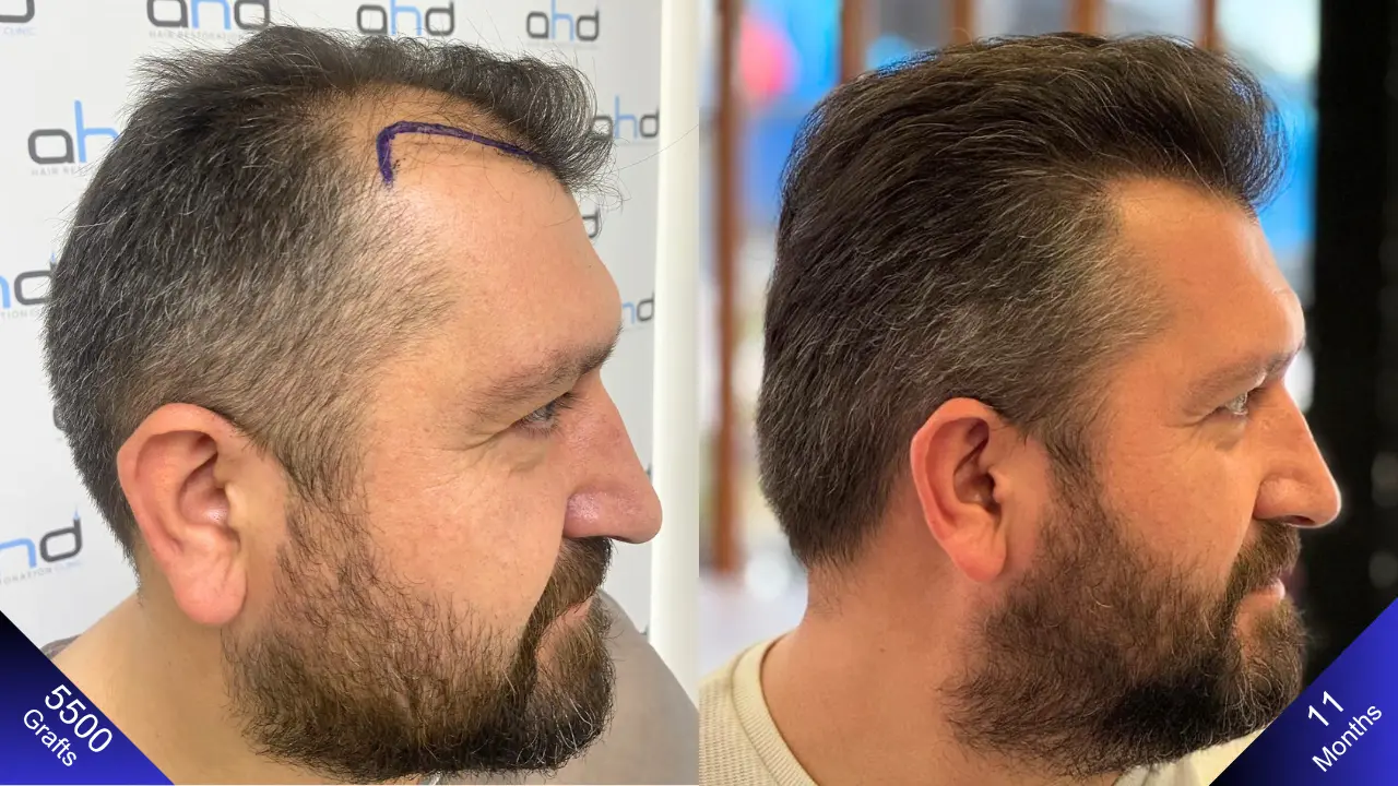 Посмотрите на результат пересадки 5000 графтов с правой стороны