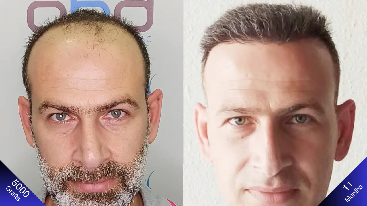 Трансплантация 5000 графтов методом DHI — отличный результат