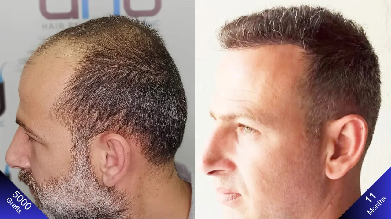 У мужчины, который был несчастлив до пересадки волос, через год появилась улыбка на лице.