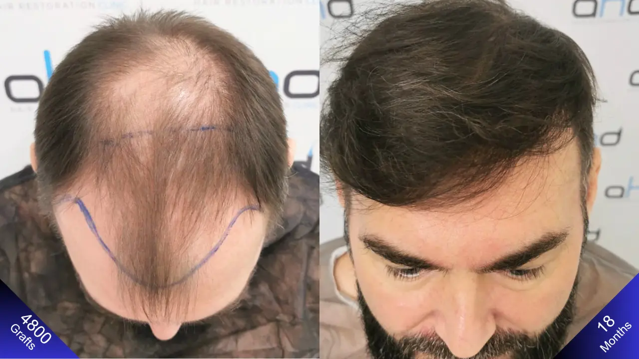 Вид сверху после пересадки 5000 волосяных графтов