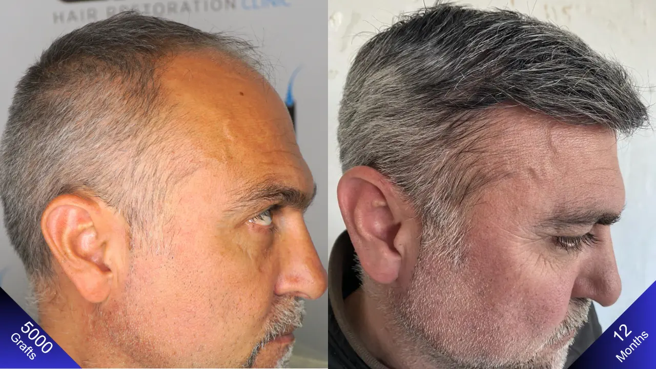 Густая и естественная трансформация с 5000 графтами