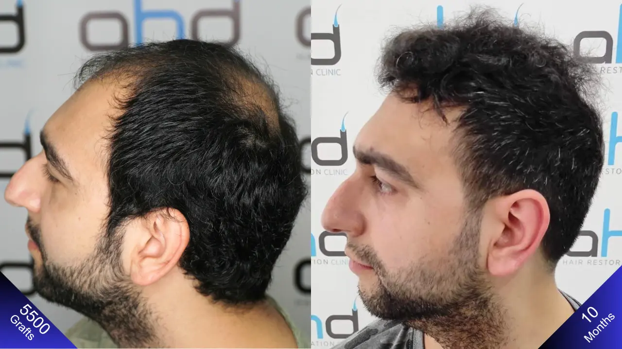 Вид слева через год после пересадки волос