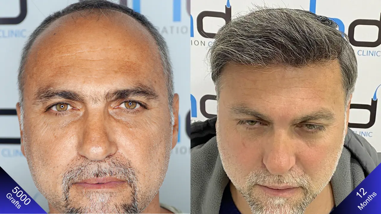 Отличное сравнение: до пересадки волос и через год после