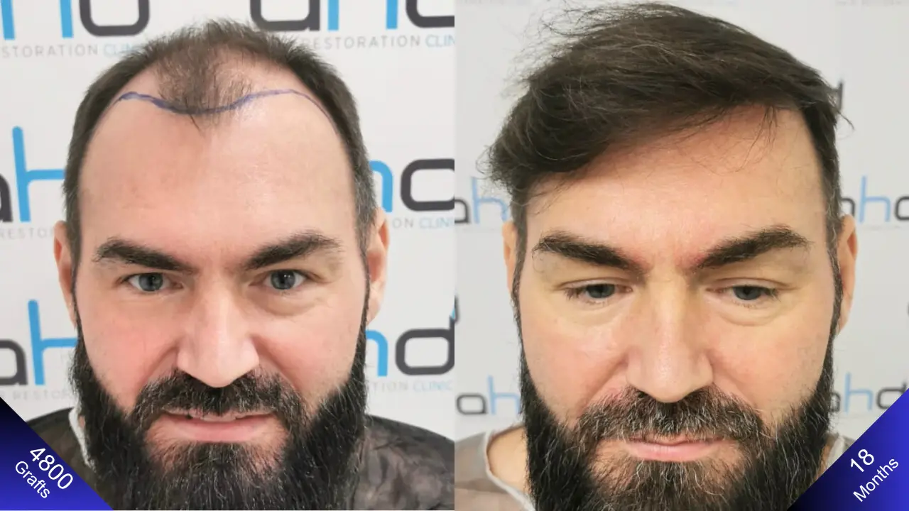 Довольный мужчина, лицо которого светится от счастья после пересадки 5000 волосяных графтов.