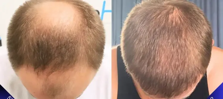 5000-grafts-haartransplantation