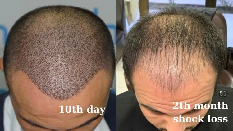A hair transplant photo of a man showing 10-day and 2-month shock loss