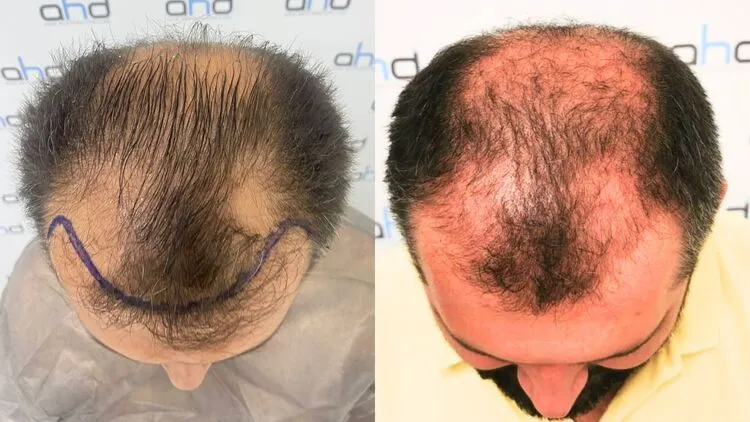 صورة لمريض يعاني من فقدان الصدمة قبل وبعد زراعة الشعر لمدة ثلاثة أشهر