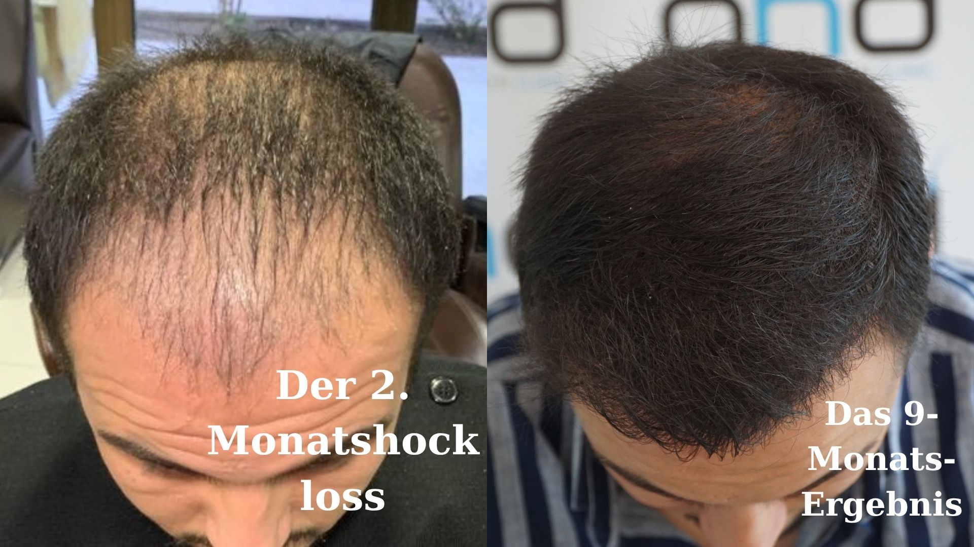 Das Foto, das das 2-Monats- und das 10-Monats-Ergebnis der Haartransplantation zeigt.