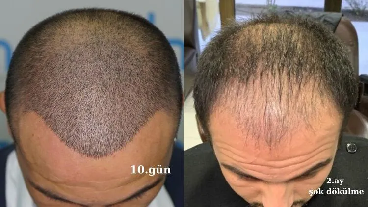bir erkeğin 10 günlük ve 2 aylık şok dökülmeyi gösteren saç ekimi fotoğrafı