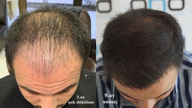 2 aylık saçekimi ve 10 aylık saç ekim sonucunu gösteren fotoğraf