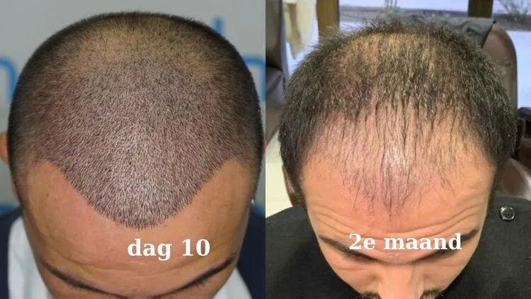 Een foto van een haartransplantatie van een man die de 10-daagse en 2-maandelijkse schokuitval laat zien.