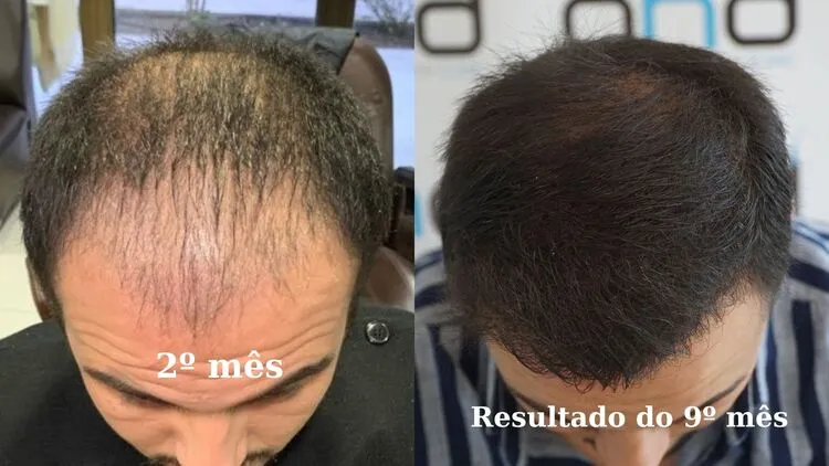 Foto mostrando a captação de cabelo de 2 meses e o resultado do transplante capilar de 10 meses.