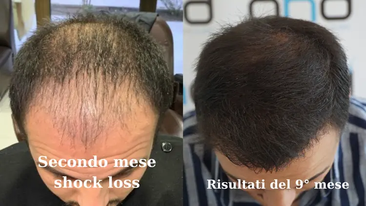 Foto che mostra il risultato del trapianto di capelli a 2 mesi e a 10 mesi