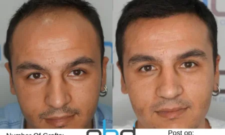 3500 grafts haartransplantatie voor en na