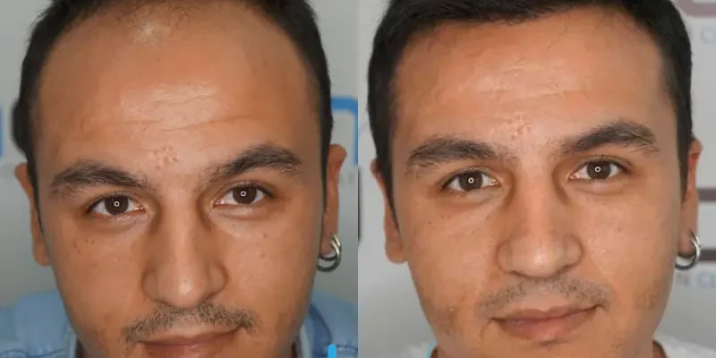 3500 grafts haartransplantatie voor en na