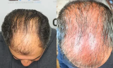 Caduta di capelli da shock per 3 mesi