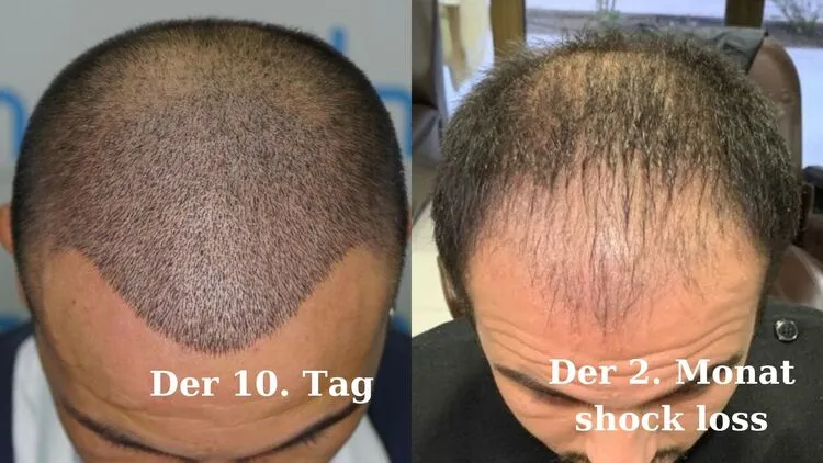 Das Foto eines Mannes, das das Haartransplantationsergebnis nach 10 Tagen und nach 2 Monaten Schockhaarausfall darstellt.