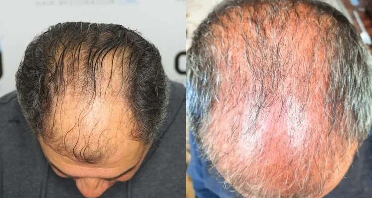 Pérdida de cabello por shock durante 3 meses
