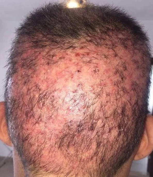 Pérdida permanente de cabello y mala apariencia debidas a una incorrecta extracción del injerto.