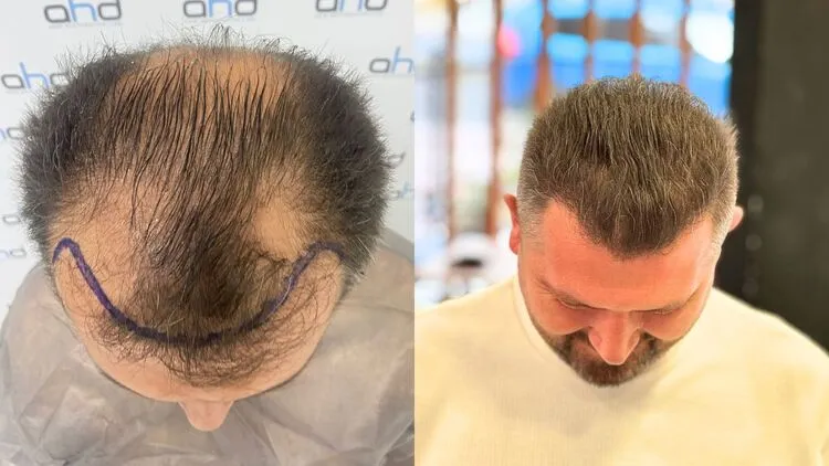Immagine prima del trapianto di capelli e dopo un anno