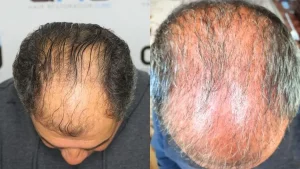 Queda de cabelo por choque há 3 meses
