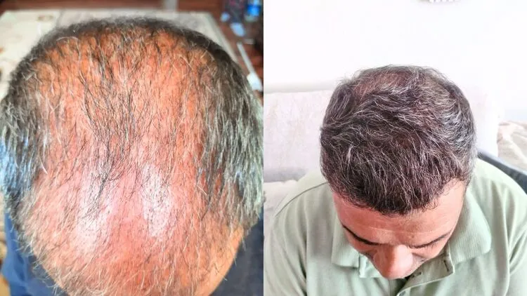 3 aylık şok dökülme ve 1 yıl sonrası