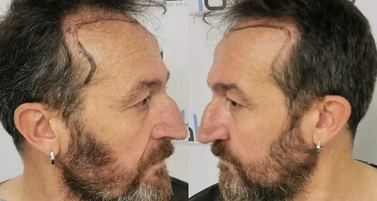 Cabelo recuando nas têmporas