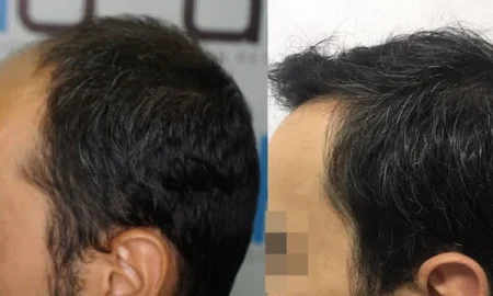 Haartransplantation an den Schläfen