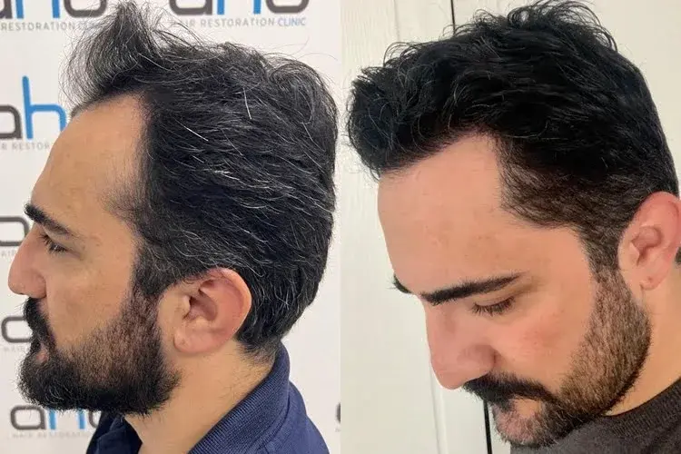 Ergebnis einer Haartransplantation im Schläfenbereich, Rechtsansicht.