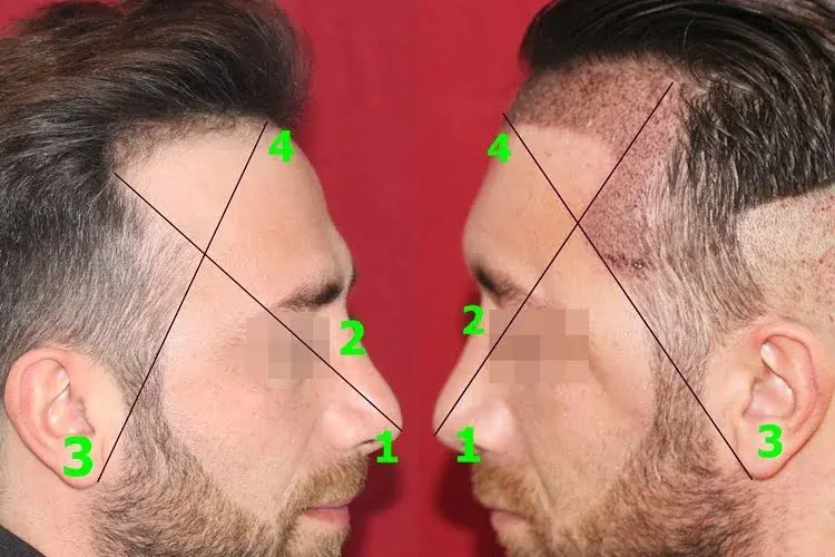 Creación de la línea de cabello en las sienes y el triángulo temporal