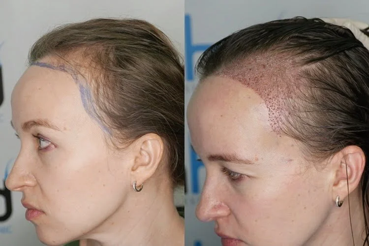 A mulher tem a linha do cabelo na têmpora totalmente composta por folículos capilares unitários.