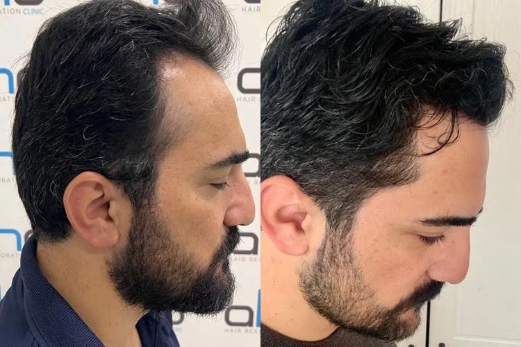 Resultado do transplante de 2500 fios na área da frente e das têmporas.