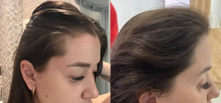 Una imagen natural de una mujer, antes y después de un trasplante de cabello en las entradas.


