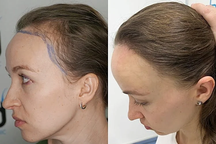 Resultado do transplante capilar na região da linha de frente e das entradas, em mulheres.