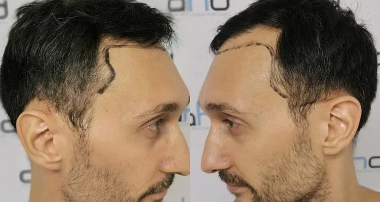 erkekte şakak çizgisi