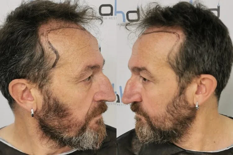 side temple hair transplant