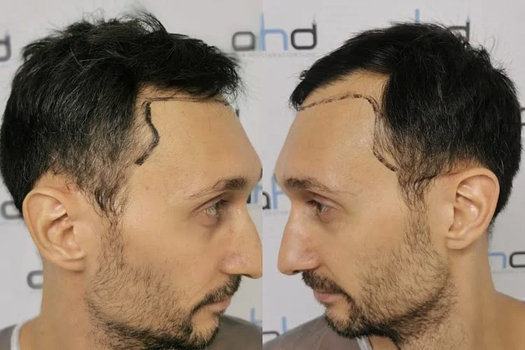 Линия висков у мужчины