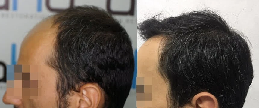 زراعة الشعر في المعبد