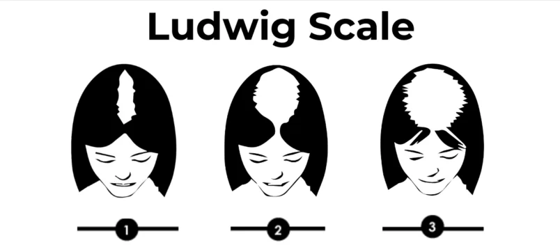 kadınlarda ludwig saç sınıflaması