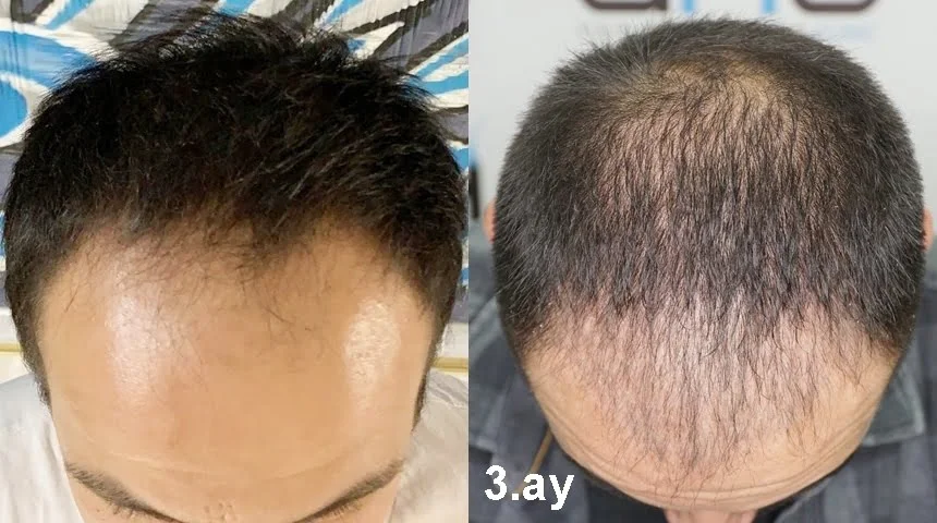 3 months after a hair transplant