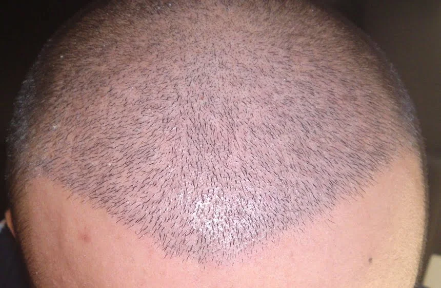 In hair transplantation, the correct angle is very important for achieving a natural appearance.