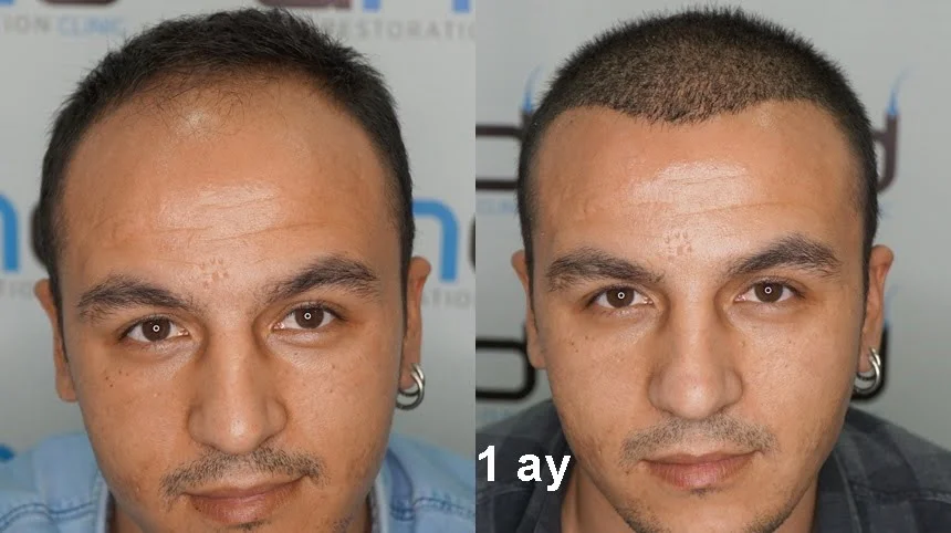 front profile view 1 month after hair transplant